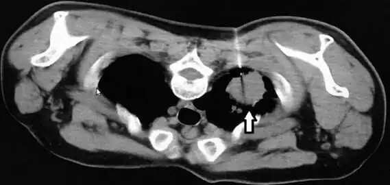 CT scan thorax revealed a soft-tissue mass with cavitation and surrounding consolidation at the right upper lobe