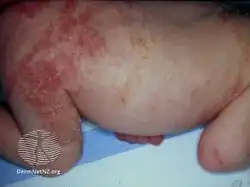 Incontinentia pigmenti