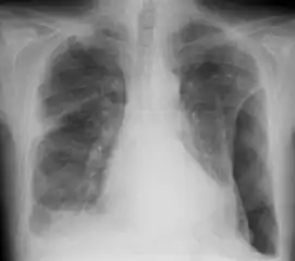 CXR of an individual affected by fibrothorax (consequence of tuberculosis)