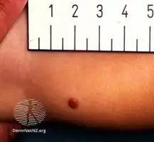 Juvenile xanthogranuloma