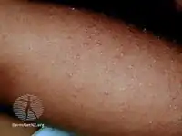 Keratosis pilaris in darker skin