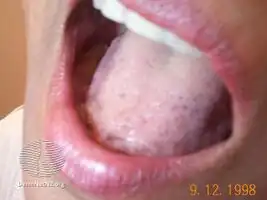 Laugier-Hunziker syndrome