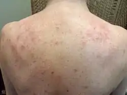 Lichenoid drug eruption