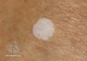 Macro photo of idiopathic guttate hypomelanosis