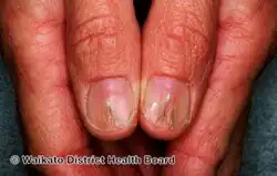 Median canaliform nail dystrophy of Heller