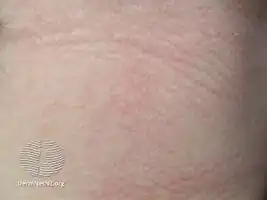 Mild lichenification