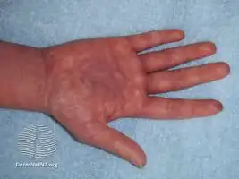 Morbilliform eruption