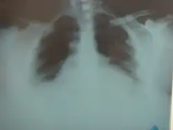 Chest X-ray: raised diaphragm due to pressure effect