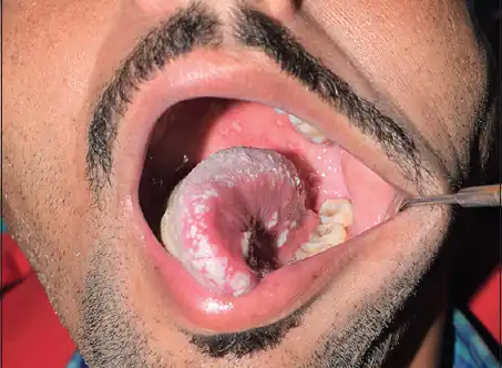 Herpetic vesicles and erythema over the left side of tongue[7]