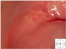 Nabothian cyst