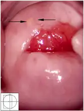 Nabothian cyst