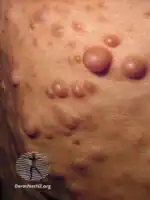 Neurofibromatosis