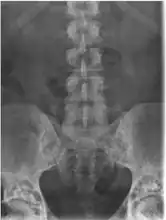 Osteopoikilosis