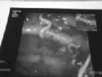 Whipworm ( multiple ulcers and blood clots in the ileum.)