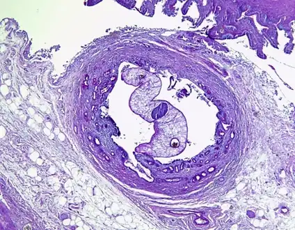 Opisthorchis sp. in Luschka's duct