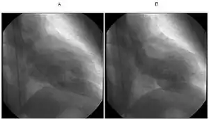 a)Diastolic phase b) systolic phase shows apical ballooning with sparing of apex indicative of takotsubo cardiomyopathy