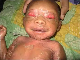 Bilateral upper lid ectropion (with collodion membrane)