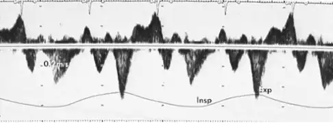 Hepatic vein flows; expiratory diastolic flow reversal characteristic feature in constrictive pericarditis is suspected