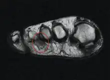 MRI image of Morton's neuroma -see circle