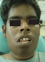 Submandibular and sublingual swelling[11]