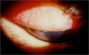 Keratoconjunctivitis