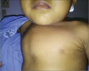 Short neck and pigeon chest