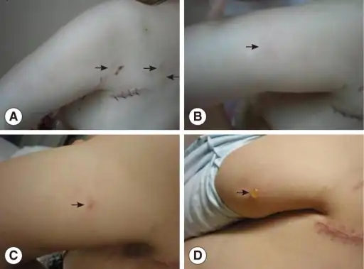 Cutaneous gnathostomiasis a) Multiple migrating subcutaneous nodules arrows b) migrating swellings 1 day after treatment with praziquantel c) subsequent papule arrow 1 day after albendazole d) subsequent blister arrow on 9th day of albendazole