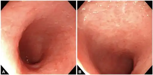 Intestinal capillariasis diagnosed by endoscopic biopsy.