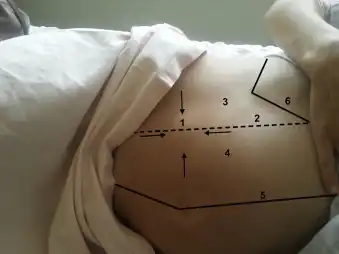 Image of the individual's abdomen with a Spigelian hernia