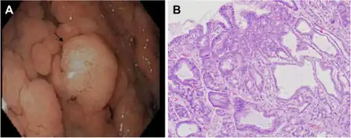 a)Pedunculated adenoma, b) photomicrograph of the same polyp showing an adenoma with low grade dysplasia