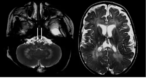 Marked enlargement of the prechiasmatic segment of the optic nerves