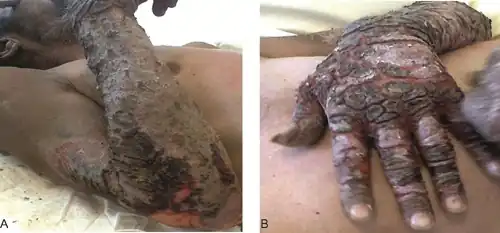 a)Pellagra on the extensor surface of forearm b) dorsa of his hand