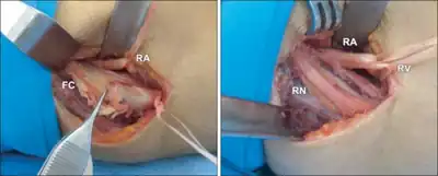 Surgery for radial neuropathy (RN) due to fibrotic cord (FC)