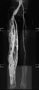 MRI-dilated turtuous blood vessels