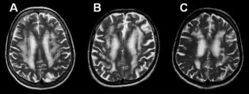 MRI-a-c)Three brains with the pure pathology of Binswanger's disease