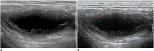 a,b)Individual diagnosed with tuberculous lymphadenitis -ultrasonography/Doppler ultrasonography
