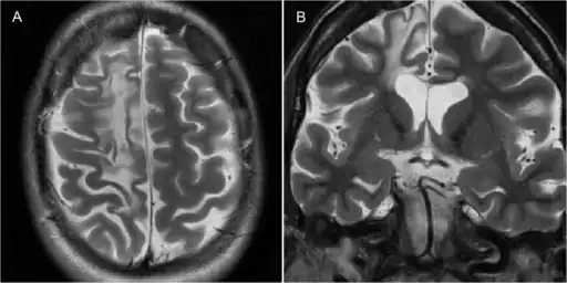 Rasmussen encephalitis resulting in atrophy of the right frontal lobe as seen on MRI.[16]