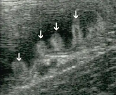Bacterial overgrowth syndrome arrow