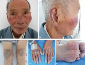 a) Dark red, infiltrative, desquamative plaques on nose/cheeks b) dark red, infiltrative plaques with scales on auricle c) confluent erythema on knees d) infiltrative erythematous plaques with scales ; all fingernails were yellow-brown/thickened e) both plantar pedis were discolored/hyperkeratotic