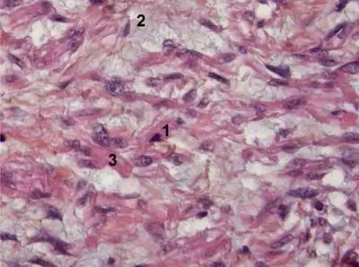 Myxoid leiomyosarcoma of bladder- 1) Abnormal mitosis 2) differentiated leiomyosarcoma 3) pools of hyaluronic acid