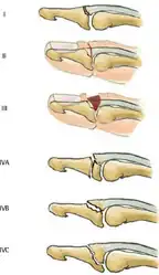 Doyle classification of mallet fingers[7]