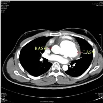 MDCT aortogram suggested left aneurysm of sinus of Valsalva and right aneurysm of sinus of Valsalva with extension into the interventricular septum.