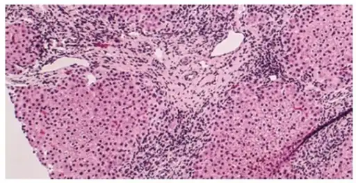 Histology of primary biliary cholangitis × 200 liver biopsy