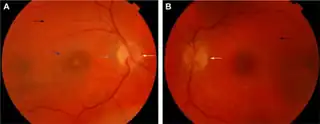 a) Retinal photographs of right eye(peripapillary atrophy (gray arrow) macular scaring (blue arrow)) b) and left eye during the convalescent phase {pale optic discs (white arrows) bright-orange choroids (black arrows))]]