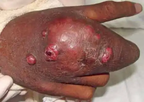 Violaceous and erythematous nodules over tumor on the back of the right hand and third finger