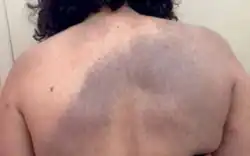 Nevus of Ito, blue-grayish macule with stained aspect