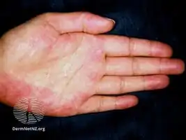 Palmar erythema