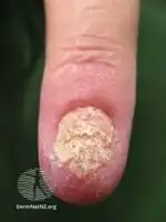 Parakeratosis pustulosa