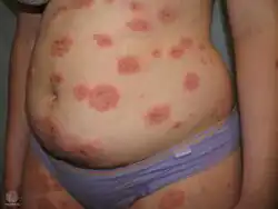 Pemphigoid gestationis