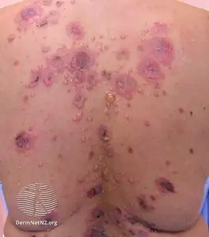 Pemphigus vulgaris